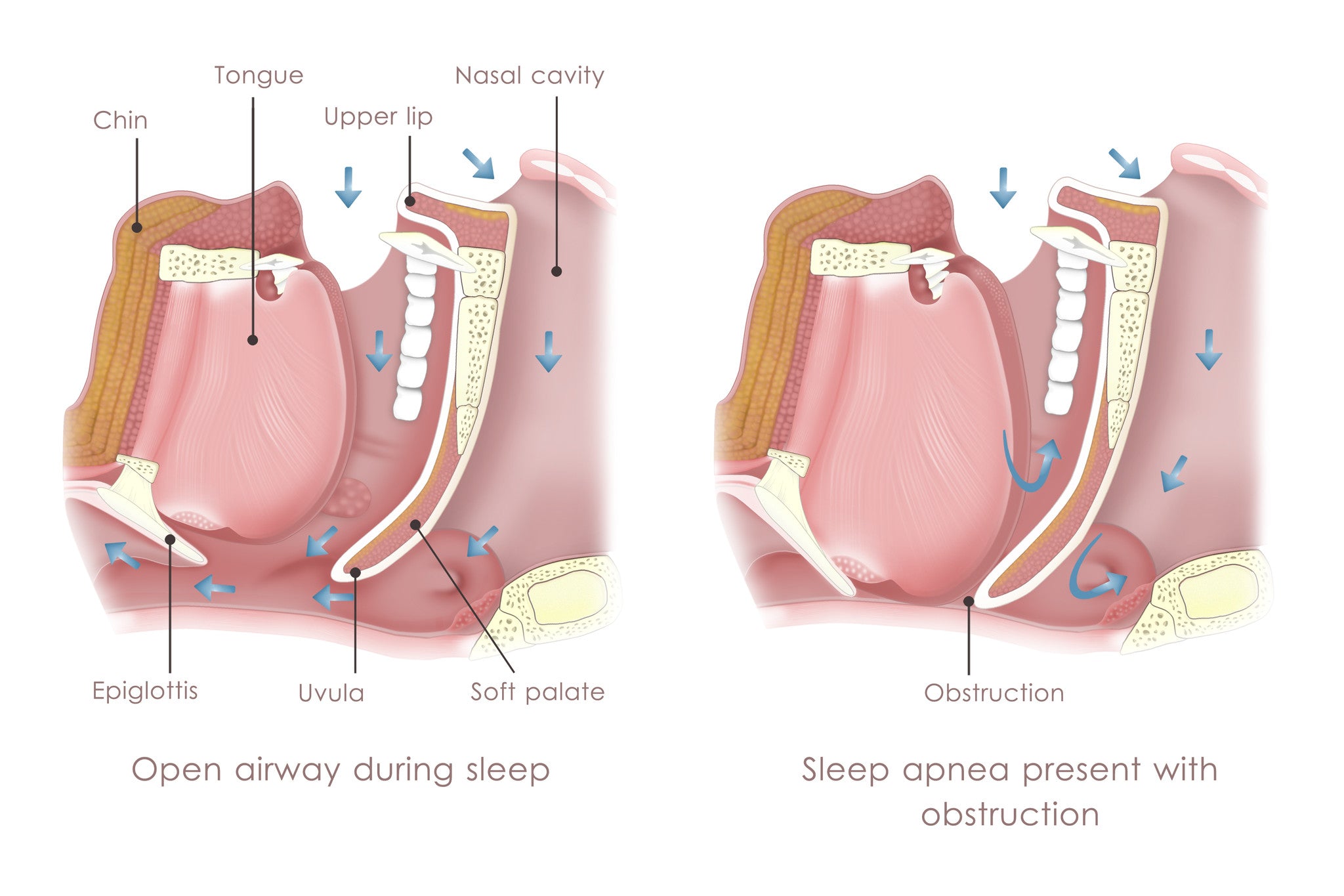 What is Sleep Apnea?